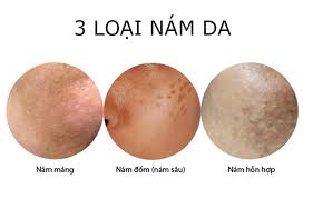 Nám Da Hình Thành Thế Nào? Giải Pháp Làm Mờ Nám Hiệu Quả Với Kem Meiduzi