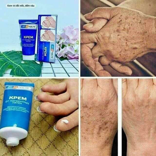Kem đồi mồi kpem Nga 50ml xóa mờ đồi mồi tay, tàn nhang dưỡng da tay trắng sáng mịn màng